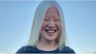 Photo of Girl Abandoned By Parents For Her Looks Wants To Prove The World Wrong – Now She Models For Vogue