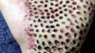 Photo of Is There a Recently Discovered Lethal Insect Species that Creates Multiple Small Holes in Palms?
