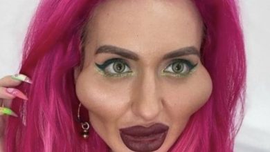 Photo of Unveiling the Woman with the World’s Largest Cheekbones Before and After Plastic Surgery.