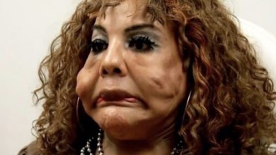 Photo of “Cement rather than silicone.” What does the woman who had cement mortar injected into her face by a beautician look like now?
