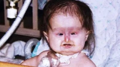 Photo of Baby Born With Unusual Syndrome – 22 Years Later She Looks Amazing
