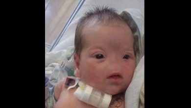 Photo of Born Without A Nose, Here’s What Tessa Evans Looks Like At 10