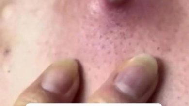 Photo of Body Acne: 10 Tips To Get Rid Of Them