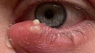 Photo of Is There a Recently Discovered Lethal Insect Species that Creates Multiple Small Holes in Palms?