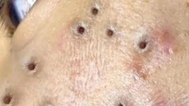 Photo of Body Acne: 10 Tips To Get Rid Of Them