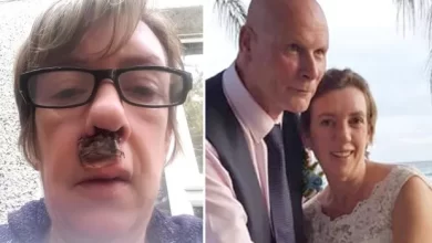 Photo of A small spot inside my nostril turned into skin cancer – I was terrified I’d be disfigured on my wedding day