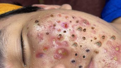 Photo of Video Relax with Squeeze Acne #23