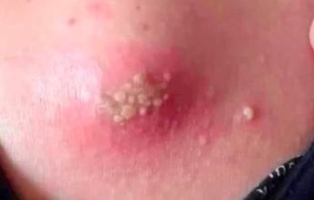 Photo of Skin Signals Used to Diagnose Serious Diseases