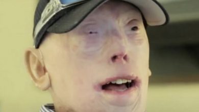 Photo of Patrick Hardison Received A New Face After Third-degree Burns, This Is Him Today – Animals