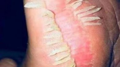 Photo of The Risks of Ignoring Fungal Infections
