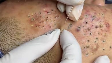 Photo of Video Relax with Squeeze Acne #42