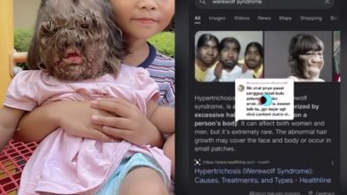Photo of Girl Born With a Face Covered In Hair Is Considered a Precious Gift From Heaven By Her Family