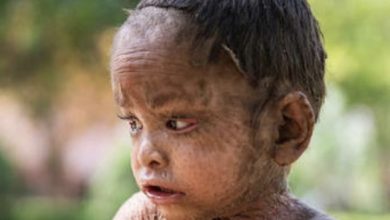Photo of Uncommon Skin, Uncommon Strength: The Boy’s Struggle and Journey to Triumph