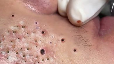 Photo of Video Relax with Squeeze Acne #49
