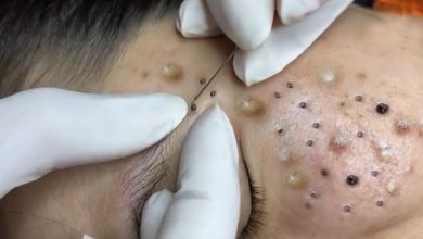 Photo of Video Relax with Squeeze Acne #51