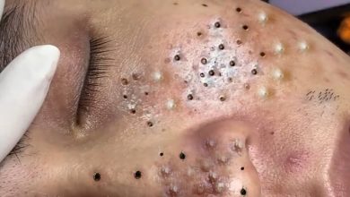 Photo of Video Relax with Squeeze Acne #47