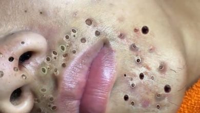 Photo of Video Relax with Squeeze Acne #45
