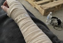 Photo of My Arm Was Wrapped From My Wrist to My Shoulder After Surgery. Then My 11-Year-Old Son Asked Me a Question That Made Me Realize What My Husband Had Been Hiding.